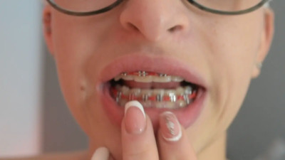 IsaGamboa - Braces