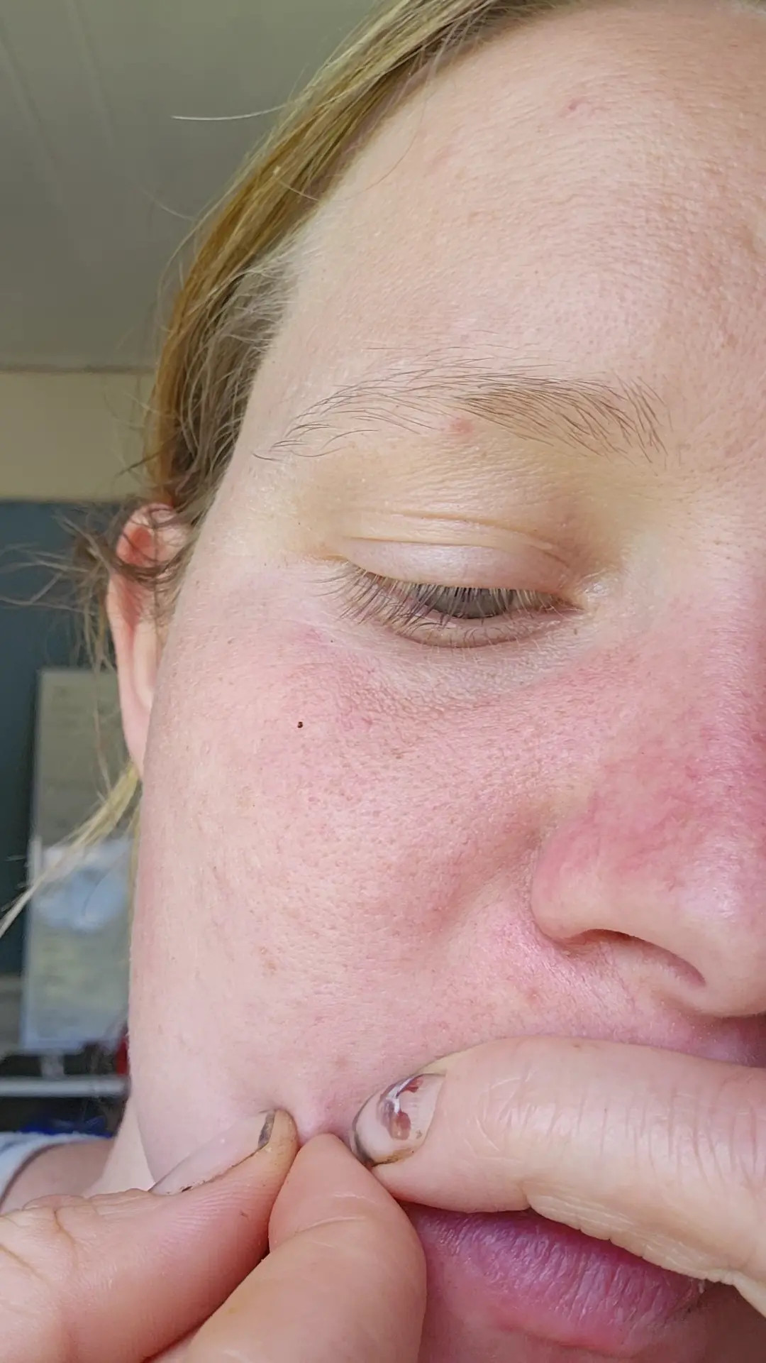 Exclusive Leak: FrankieQuinn - Popping a satisfying face pimple - Stream in FullHD | Hotleakxxx.com
