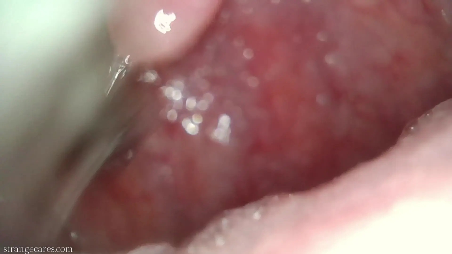 Exclusive Leak: strangecares - uvula endoscopy & metal chopsticks - Stream in FullHD | Hotleakxxx.com