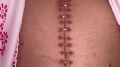 Nali Marie - Belly Staples Removal After 2 Surgeries From A Car Accident